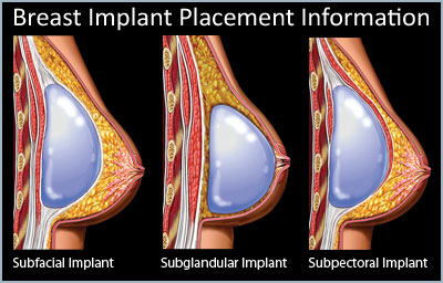 breast implant